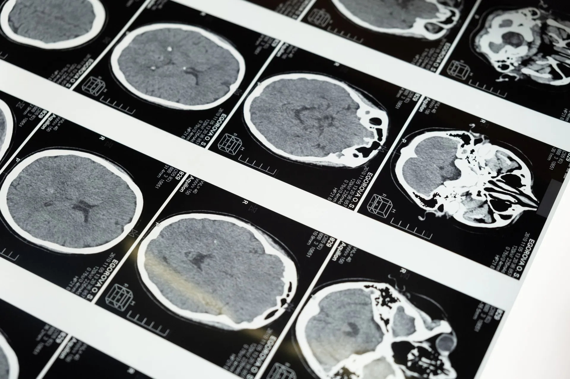 Sheets of brain scan imaging laid out across a lightbox
