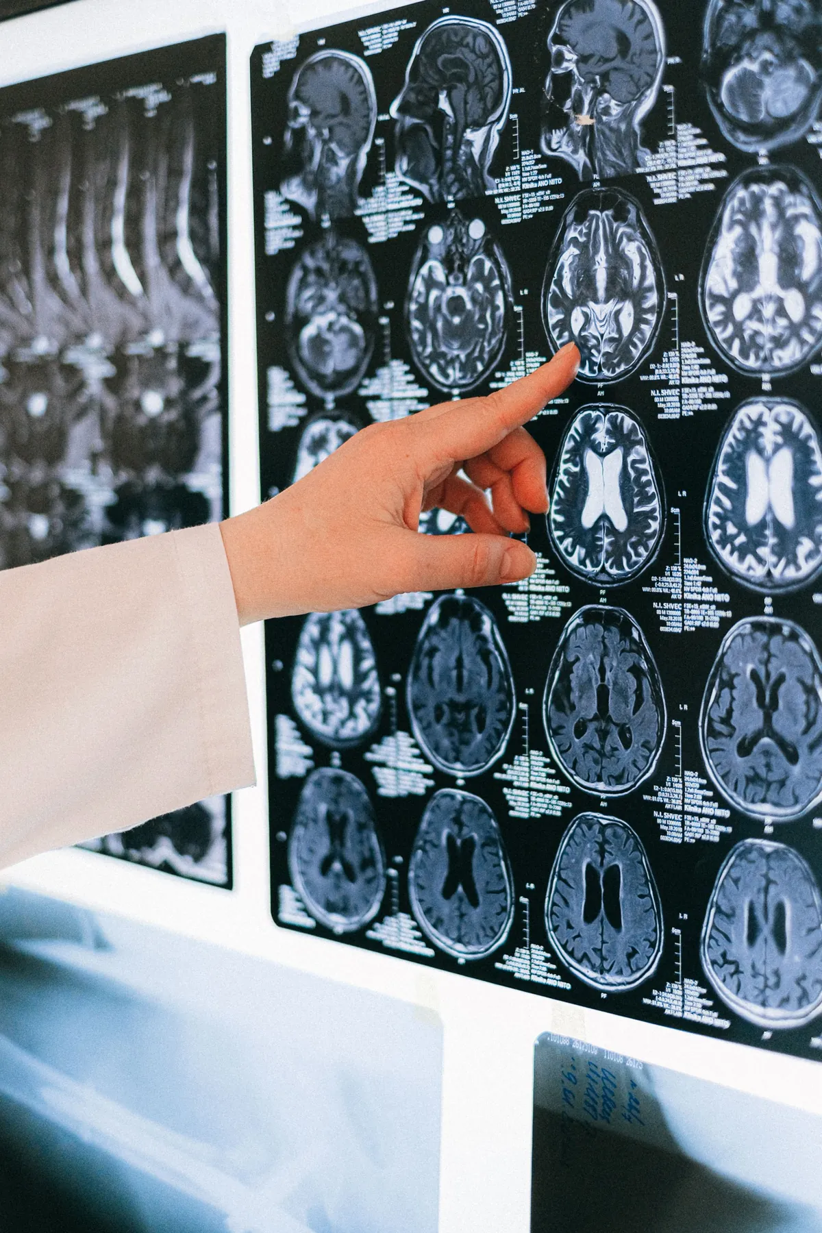 A clinician's hand pointing at brain scan films on a lightbox